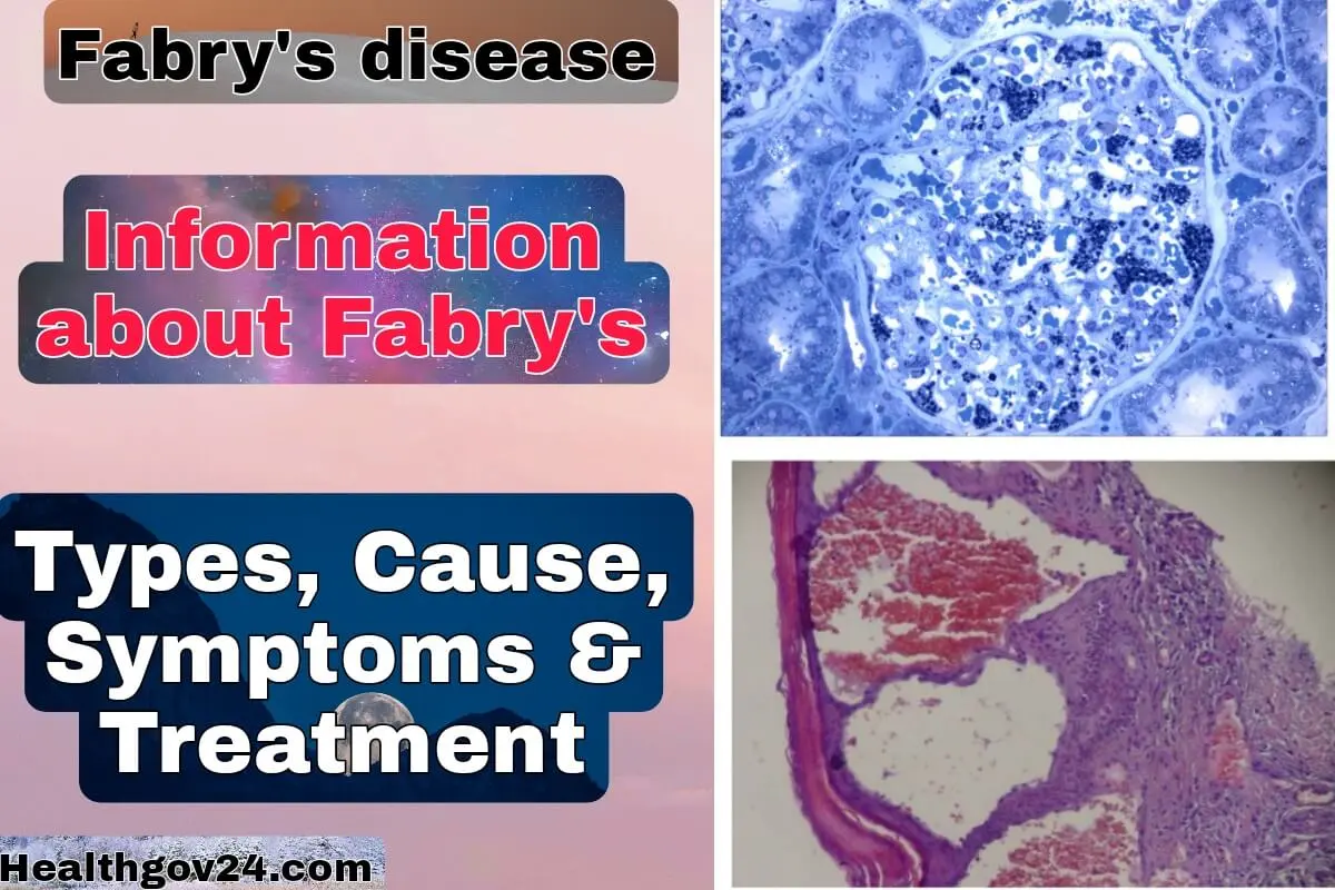 fabry's disease image, fabry's disease image 2023